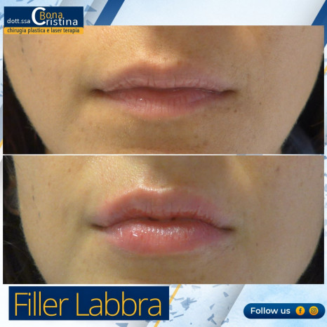 Filler Labbra  prima e dopo Dott.ssa Cristina Bona